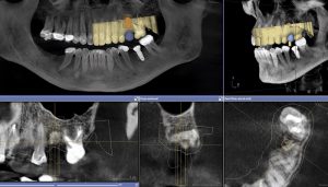 آشنایی با تصویربرداری CBCT و کاربرد آن