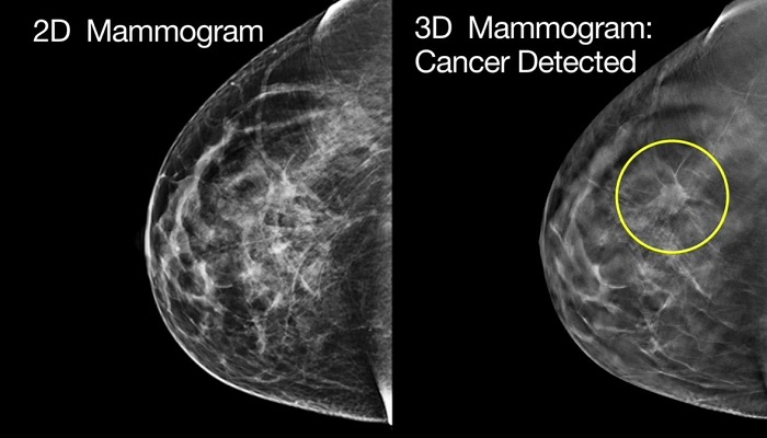 ماموگرافی چیست؟