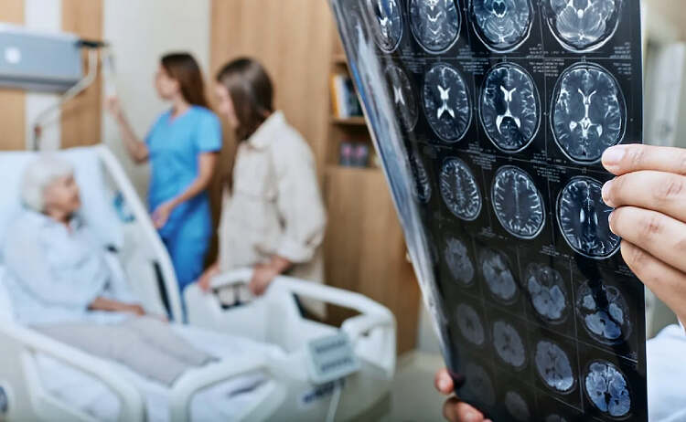 بیماری آلزایمر با MRI