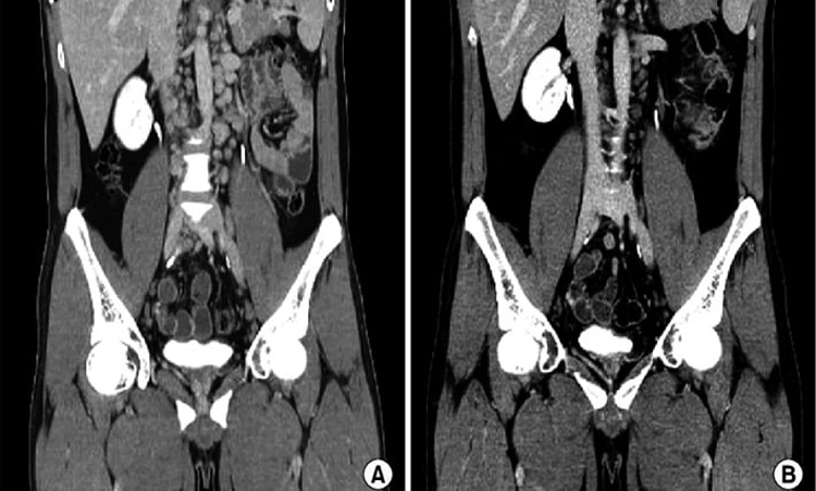 مزایا و معایب سی تی اسکن اسپیرال