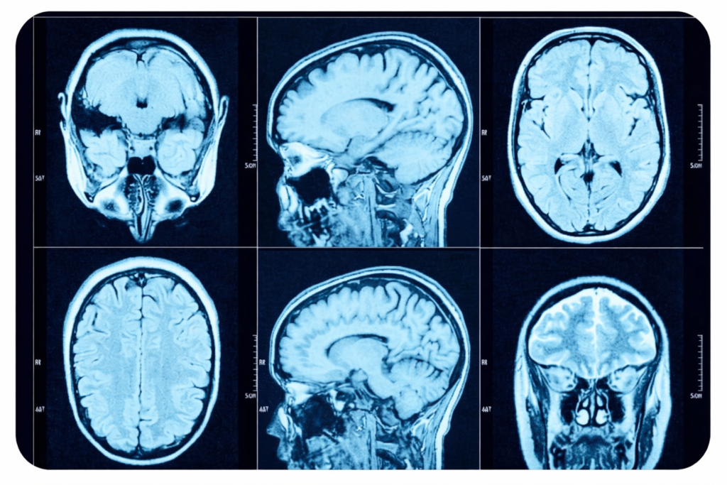 سی تی اسکن مغزی