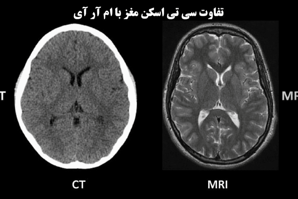 ارزش تشخیصی سی تی اسکن در ضایعات فضاگیر مغزی