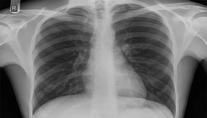 سی تی اسکن قفسه سینه
