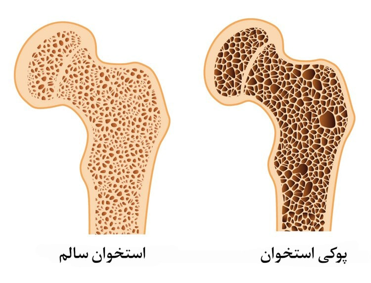 بررسی عکس پوکی استخوان و تشخیص عالئم هشداردهنده